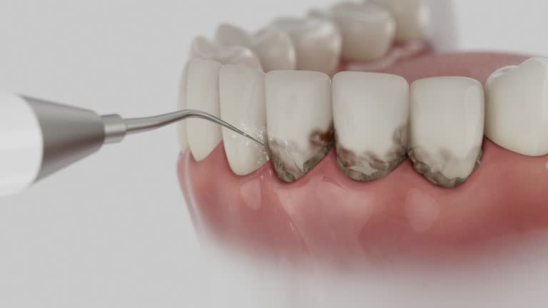 Trusted Invisalign Clear Aligners service in West Lafayette, OH - Dentist Open Now